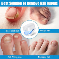 VELCURA™ Nail Fungus Laser Treatment Device