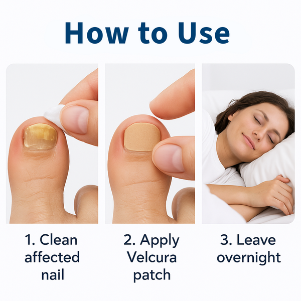 VELCURA™ Fungal Nail Patches