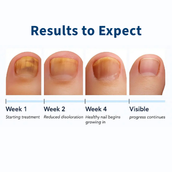 VELCURA™ Fungal Nail Patches