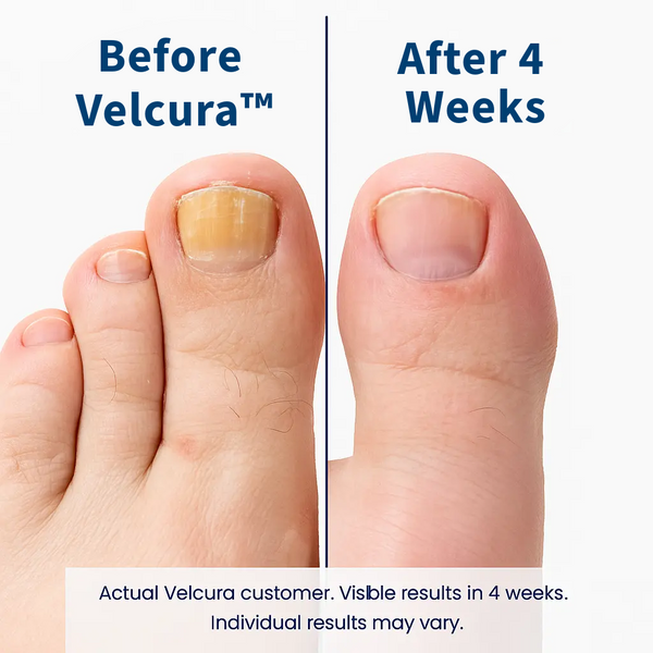VELCURA™ Fungal Nail Patches