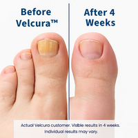 VELCURA™ Fungal Nail Patches