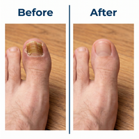 VELCURA™ Fungal Nail Patches