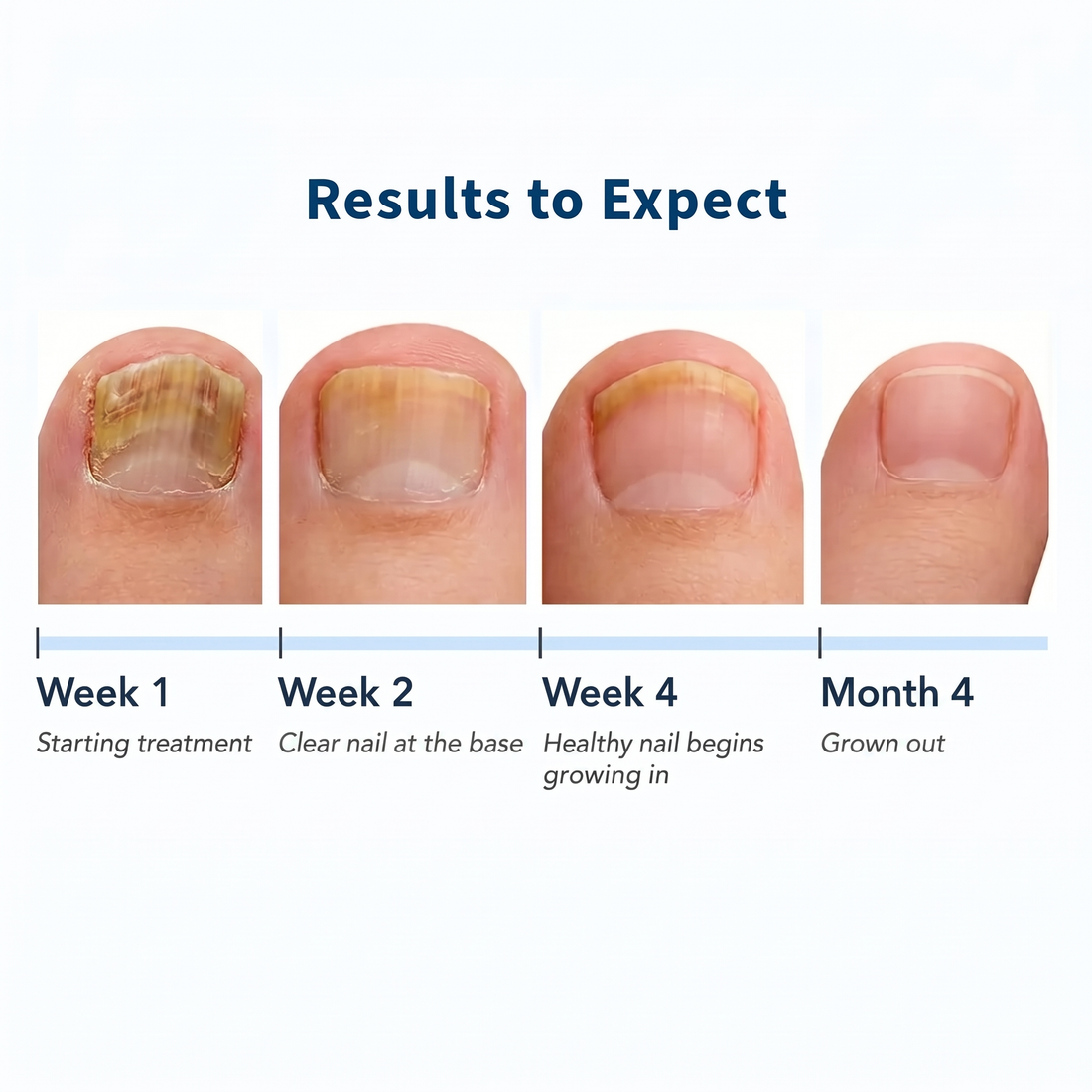 VELCURA™ Fungal Nail Patches VELCURA
